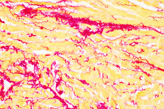 Histological image illustrating tissue scarring